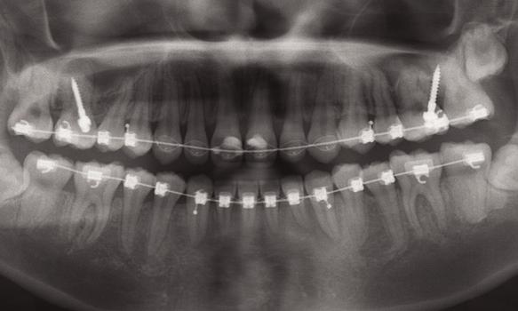 A progress panoramic appliances were removed. The total active treatment radiograph was taken to evaluate axial inclinations time was 32 months. nd 29M 2M Fig.