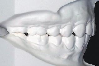 2: The second molars were not well aligned. limitations (ANB 9 ).