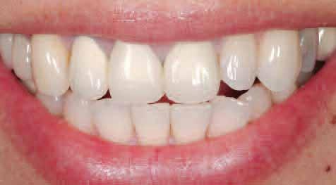 This article presents the case of a 35-year-old female patient with existing porcelain-fused-to-metal crowns and significant darkening of the gingiva surrounding the
