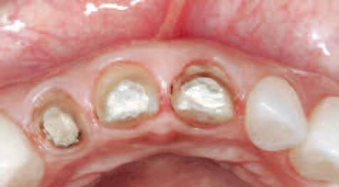 Figs 3a and 3b Intraoral views at the end of the bleaching process