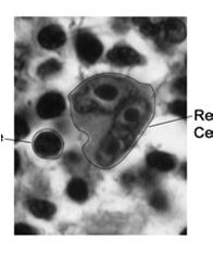 Hodgkin: Reed-Sternberg cells Size between 20-50 microns; Amphofilic, finely granular/homogenous cytoplasm; Two mirror-image nuclei ("owl eyes") each with an eosinophilic nucleolus and a