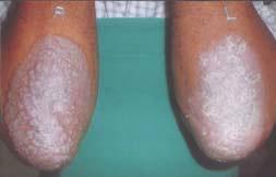 One patient developed fissuring with tazarotene. With clobetasol, the common side-effect was hypopigmentation which was seen in seven patients (19.4%). Skin atrophy was seen in three patients (8.
