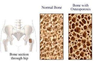 Definition Normally, bone mass decreases in adults as they grow older, about 0.7% per year. Osteoporosis speeds up the process of bone loss. There are two types of Osteoporosis: Primary and Secondary.