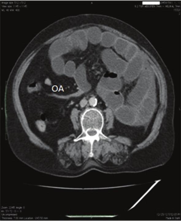 2 Case Reports in Surgery (a) (b) Figure 1: CTimages demonstrating intestinal malrotation. On axial image (a), obstructed area (OA) indicates the obstructed part of terminal ileum.