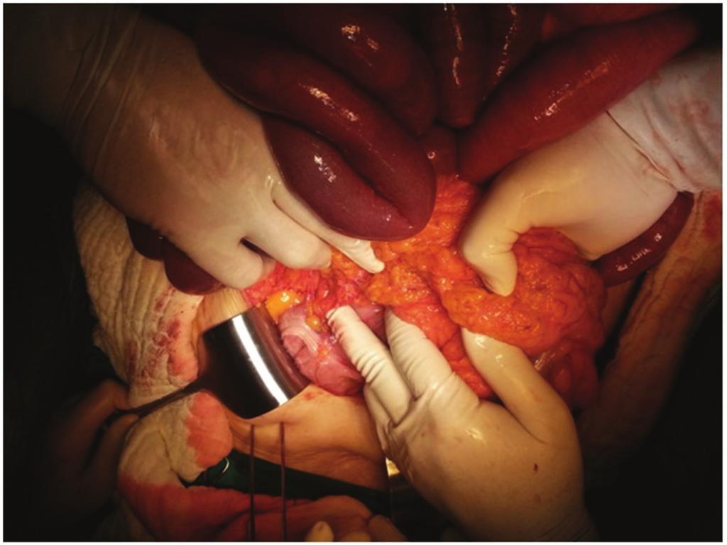 Case Reports in Surgery 3 Figure 3: The place where terminal ileum comes out of transverse mesocolon. transverse colon are supplied from the superior mesenteric artery (SMA).