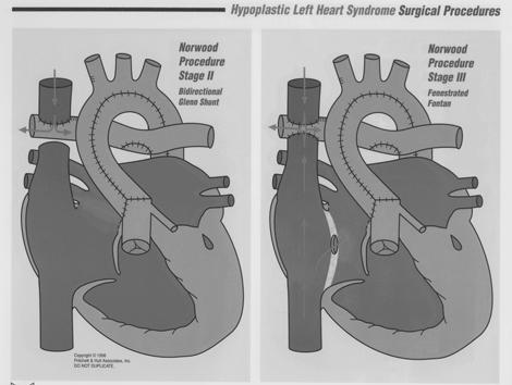 Heart Syndrome: 1% of CHD, most common