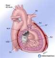 EBSTEIN S ANOMALY PREOPERATIVE PATHOPHYSIOLOGY SEVERE TRICUSPID