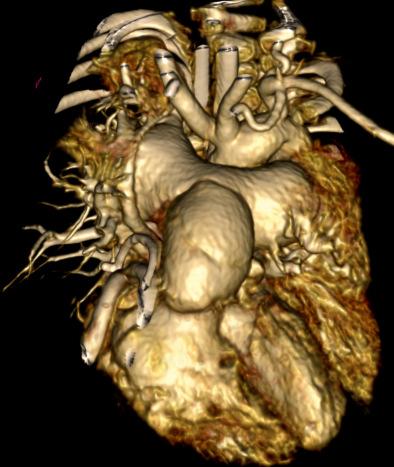 congenital heart disease CTA role for