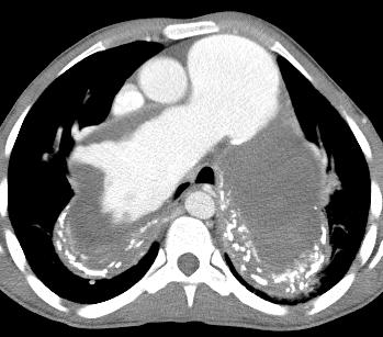 9/8/2009 Pulmonary artery thrombus Metal stent