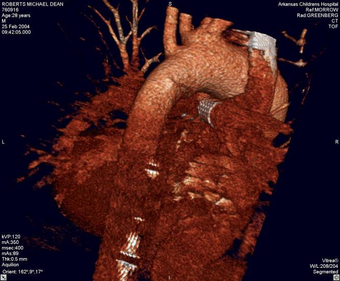Occlusion of left pulmonary artery by thrombus