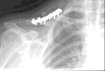 Trauma Complications Webinar: Clavicle Fractures Peter A.