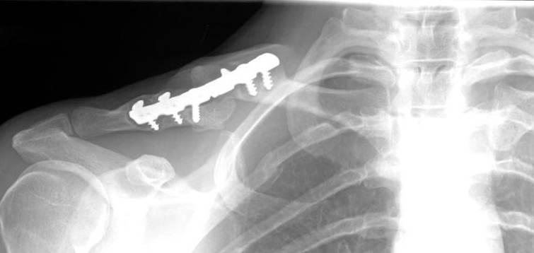 Female 8 years status post ORIF diaphyseal clavicle nonunion Chief Complaint: Pain, cosmesis,