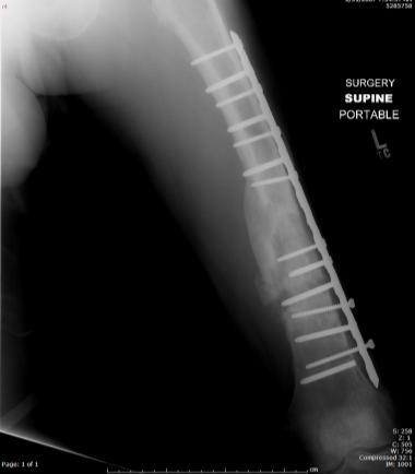 Failed Femur Fractures Bradley Dart MD Failed Femur Fractures 62 y/o Male Fractured