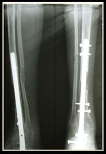 Result shows correction of FFD knee