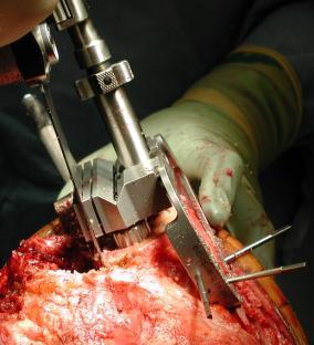 Drawbacks of Bone Grafts for Rx of Femoral Bone Defects Preparation of desired graft shape is imprecise (free-hand): Joint Line establishment difficult Allografts of correct size/shape may be
