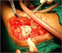 Circumflex Femoral Artery is preserved.
