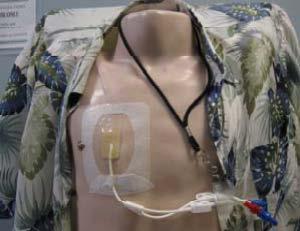 What is a central venous catheter? A central venous catheter is a thin, flexible tube inserted into a large vein in your chest (see photo with mannequin below).