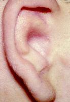 Atresia/Stenosis of External Ear Canal: The Congenital Auditory Atresia (CAA) rate is 1 in 10,000-20,000 live births.