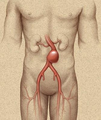 Abdominal Aortic Aneurysm (AAA) Affects 5-6% of the population