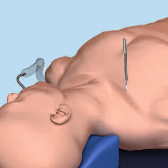 Implantation: Minimally Invasive Approach 1 Surgical approach (minimally invasive) The operation is performed from medial towards lateral to minimize the risk of harming central vessels.