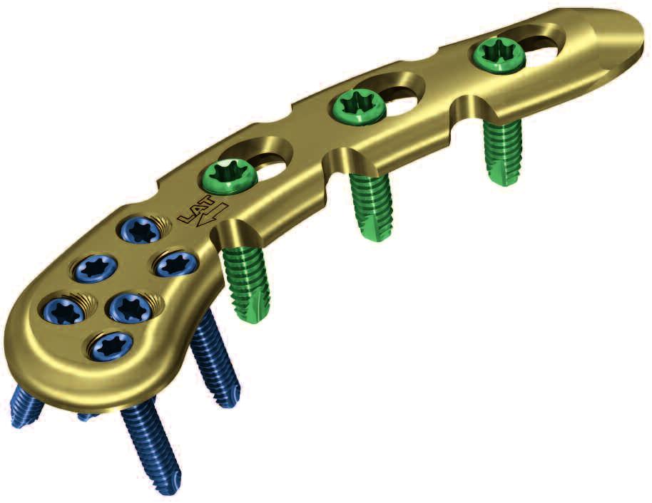 allow any necessary plate contouring Shaft holes 3.5 mm locking or 3.5 mm cortex screws Small (2.