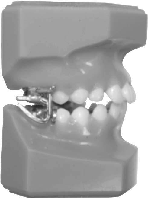 ALLESEE ORTHODONTIC APPLIANCES SECTION 11 PAGE 5 MARA Mandibular Anterior Repositioning Appliance The MARA is a simple and durable Class II corrector that is attached to the patient s first molars