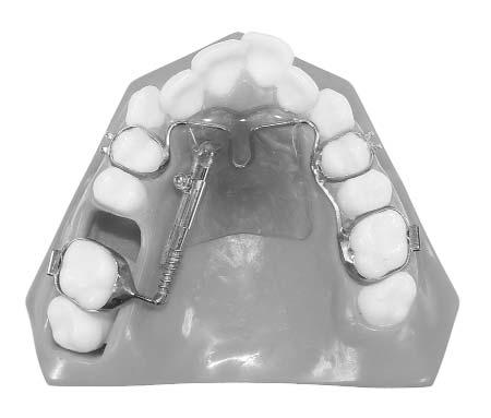 SECTION 11 PAGE 8 ALLESEE ORTHODONTIC APPLIANCES Molar Distalization and Arch Development Enhance your options for nonextraction therapy by using phase one fixed or removable appliances.