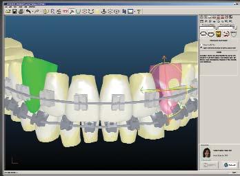 APPLIANCE SYSTEMS SECTION 1 PAGE 19 Insignia Custom Designed Orthodontics Start With The End In Sight.