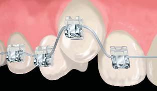 Damon passive self-ligating brackets allow freedom of movement and thus faster results with gentler forces. It s the biologically sensible way to improve tooth position and facial aesthetics.