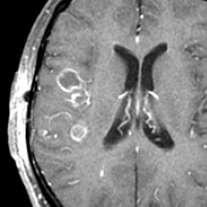 NEUROCYSTICERCOSIS Common disease Ring enhancement in