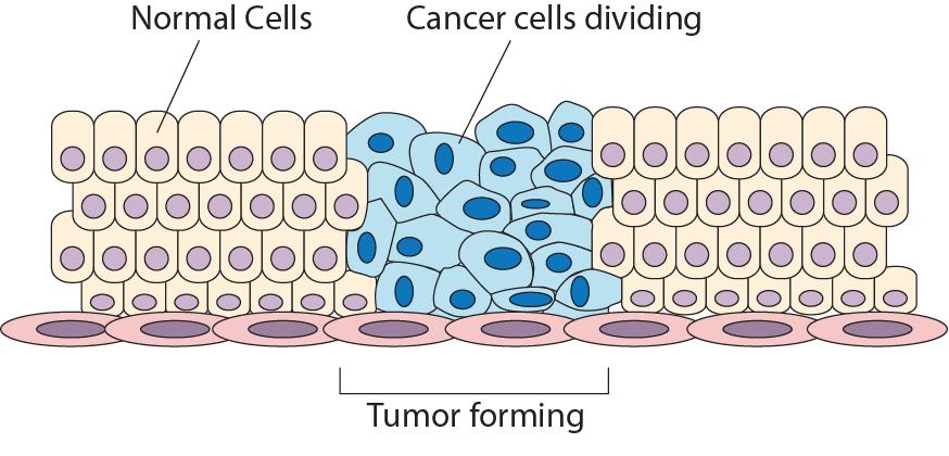 cancer A disease that occurs as a result