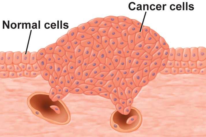 VI. Cancer: Cell divisin must be cntrlled, therwise cell grwth will ccur withut limit (cancer) mutatins lead t changes in the prteins/enzymes that regulate the cell cycle = a cell r grup f cells that