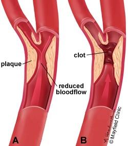 What is carotid artery stenosis A progressive narrowing of the carotid arteries in a process called atherosclerosis Over time, the buildup of fatty substances and cholesterol narrows the carotid
