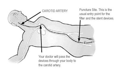 Carotid artery stenting Minimally invasive endovascular procedure that compresses the plaque and widens the