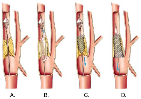 to high-grade carotid stenosis greater than 70% 2) have other medical conditions that increase the risk of
