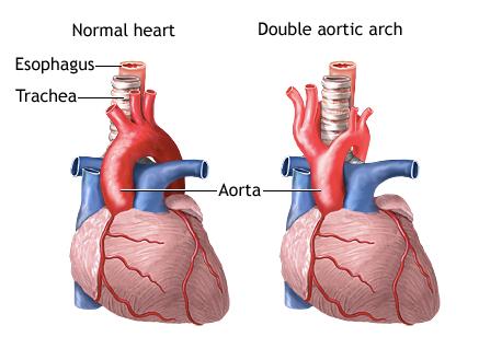 Double aortic arch It s the most symptomatic type of aortic arch variant. It s about 50-60% of vascular rings.