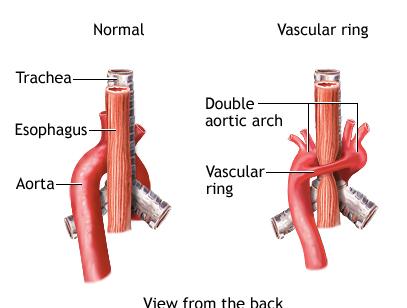The two parts to the aorta have smaller arteries branching off of them. The condition occurs equally in males and females.
