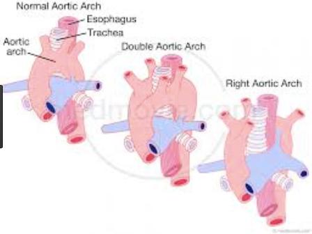 Right sided aortic arch It s a type of anomaly characterized by the aortic arch coursing to the right of the trachea It just occurs in approximately 0,1% of the population.