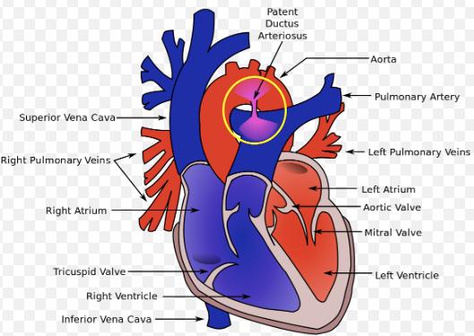 Patent ductus arteriosus Congenital cardiac anomaly where there is persistent potency of the ductus arteriosus, which is a normal connection of the fetal circulation between the aorta and the