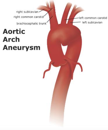 Aortic arch aneurysm Aneurysms (bulging of the aorta) occur due to molecular and connective tissue changes in the wall of the aorta.