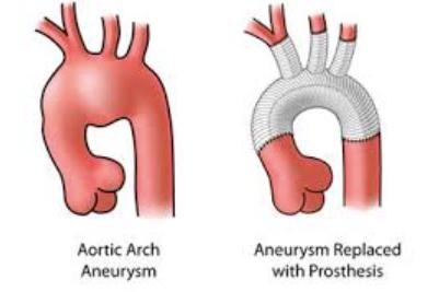 Treatment: OPEN REPAIR: remains the gold standard in aortic arch repair for