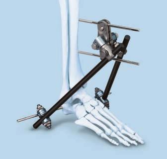 Indications The Large External Fixation System is intended to provide treatment for