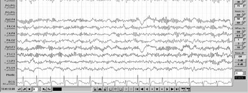 5% of EEG, most commonly in young adults No longer used names : wicket, comb or arceau rhythm Mu rhythm Mu waves intermix or alternate with beta activity, often have half the frequency of beta