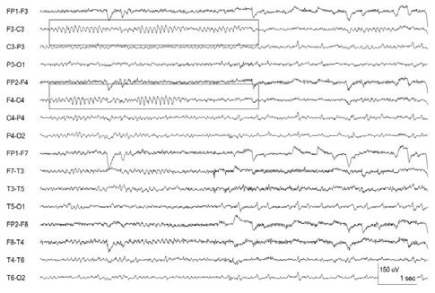 sawtooth shape, 160-250 msec in duration Presence when the patient is looking at images containing visual detail Voltage: moderate amplitude