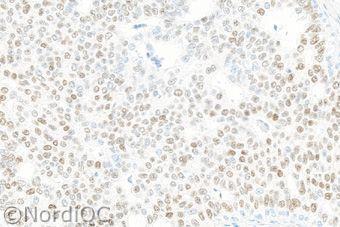 Fig. 3a Optimal ER staining of the breast ductal carcinoma no. 4 with 60 90% cells positive.