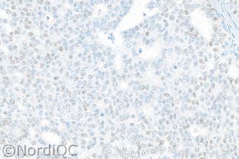 Fig. 3b Insufficient ER staining of the breast ductal carcinoma no. 4 with 60 90% cells positive using same protocol as in Figs.