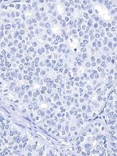 5b Left: ER staining of the breast ductal carcinoma no. 5 with a high level of ER expression.
