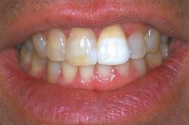 teeth or pulps. 13 Tooth sensitivity is less of an issue with the introduction of potassium nitrate as an adjunct to the whitening procedure.