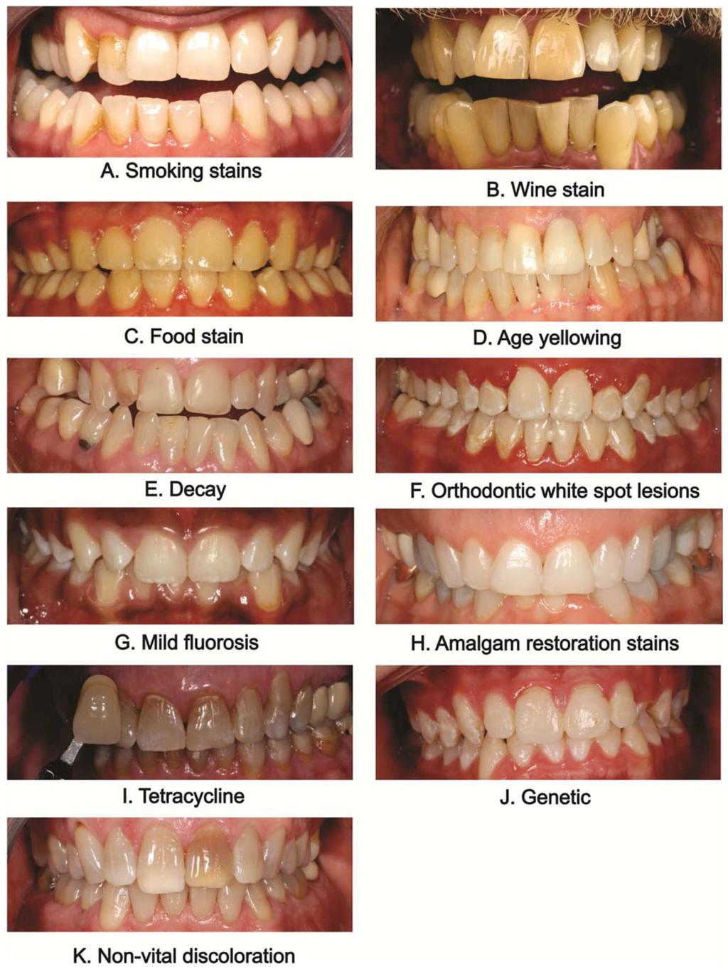 Carey Page 11 Figure 1. Examples of tooth staining. Extrinsic staining examples: A. Smoking; B. Wine stain; and C. Food stain. Intrinsic staining examples: D.