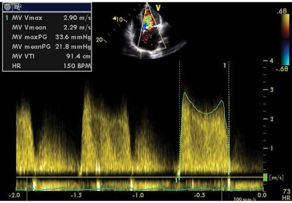 2 cm diameter, 35 cm 2 end-systolic area), a severely stenotic mitral valve with a mean pressure gradient of 22 mm Hg and a mitral valve area of 0.6 cm 2 (Figure 1). Figure 1.